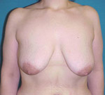 Patient # 85591 Before Photo # 1